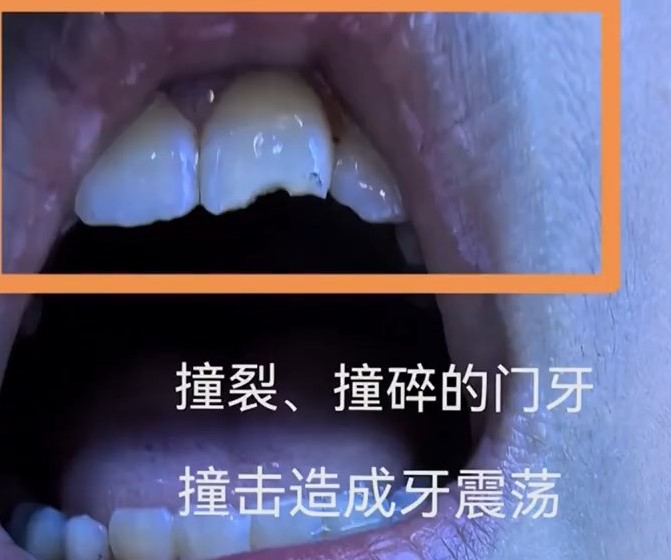 吴女士儿子事后门牙断裂。广东电视台